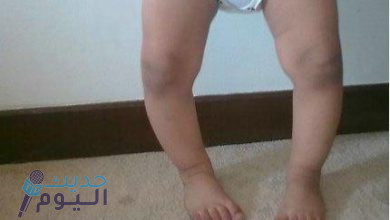 تقوس الساق عند الأطفال الأعراض والأسباب وطرق العلاج