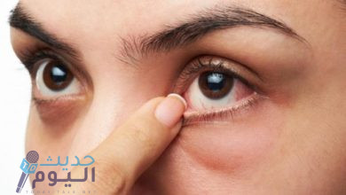 اسباب جفاف العين خلال فصل الصيف وطرق العلاج الصحيحة