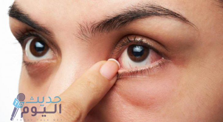 اسباب جفاف العين خلال فصل الصيف وطرق العلاج الصحيحة